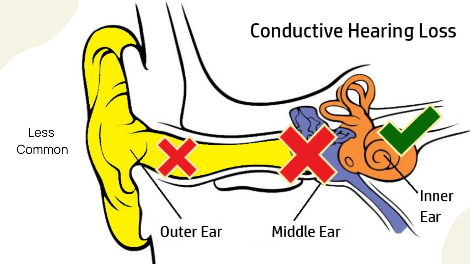 Image of conductive hearing loss