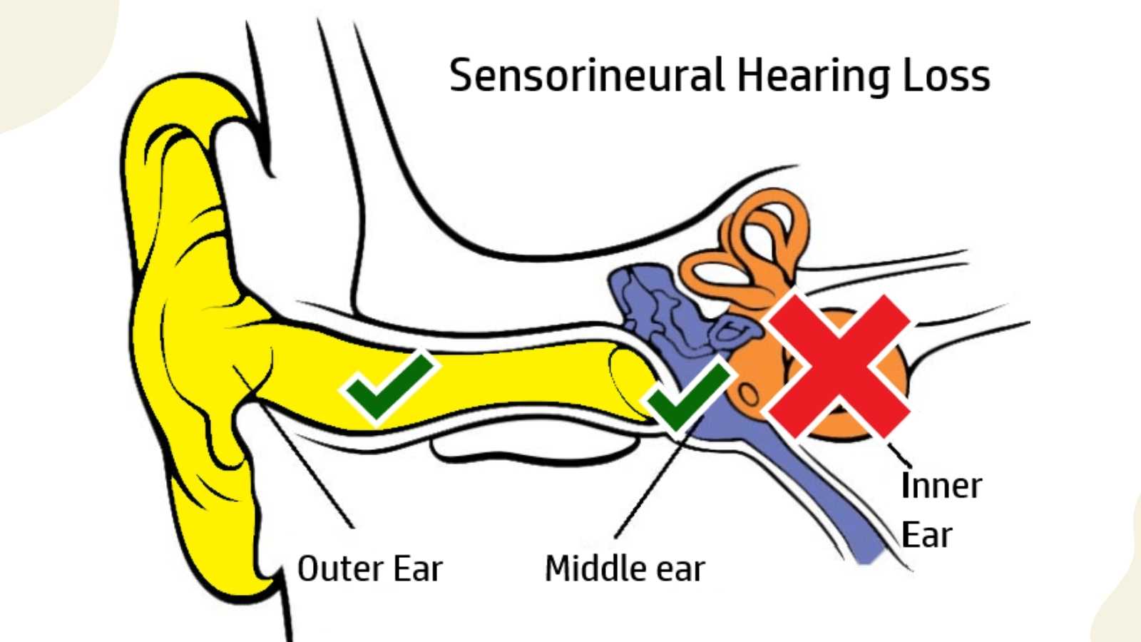 Image showing sensorineural hearing loss